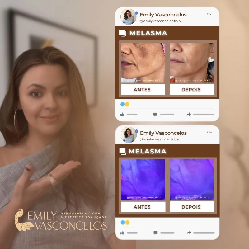 Antes e depois - Skinbooster